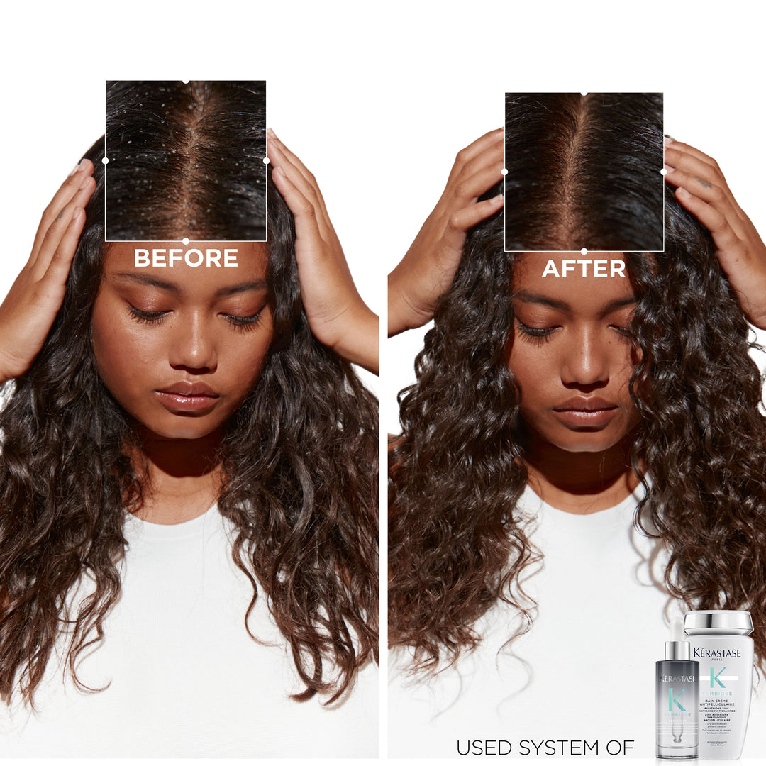 Kerastase Symbiose Anti-dandruff Deep Treatment Hair Care Set before after
